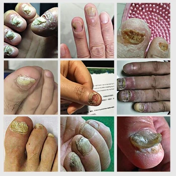 Unghii Fungice Tratament De Îngrijire De Picioare Esența Unghii Picior De Albire Unghii Deget De La Picior Ciuperca Îndepărtarea Gel Anti Infectie Paronichie Onychomycosis