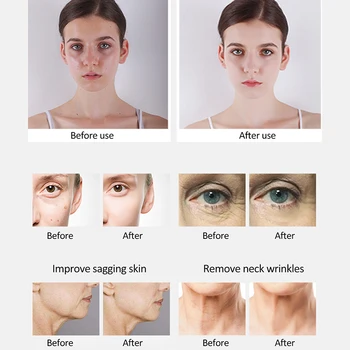 Tactile Vibrat Masaj ION Wrinkle Remover Mezoterapia Faciala pentru Esența Fata de Machiaj cu Role Remover Îngrijire a Pielii Faciale Dispozitiv